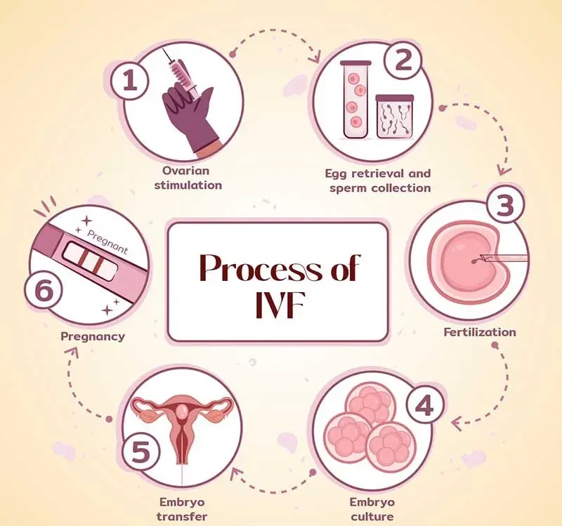 IVF试管婴儿流程：体外受精医疗程序完整解析