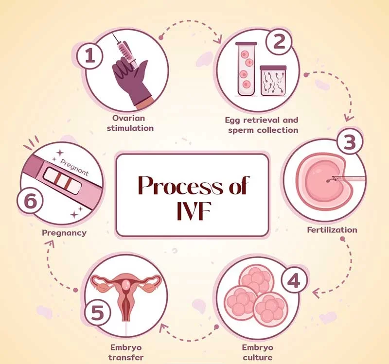 IVF试管婴儿流程：体外受精医疗程序完整解析